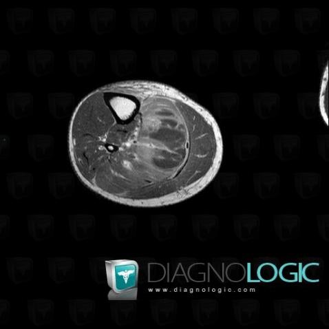 Abscess, Muscles - Leg, MRI