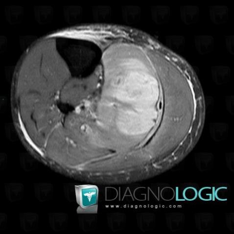 Abscess, Muscles - Leg, MRI