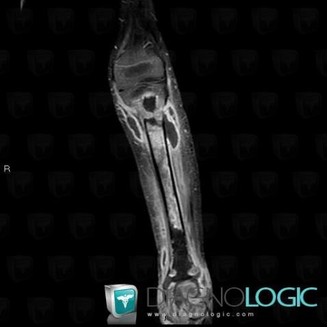 Abscess, Muscles - Leg, Other soft tissues/nerves - Leg, MRI