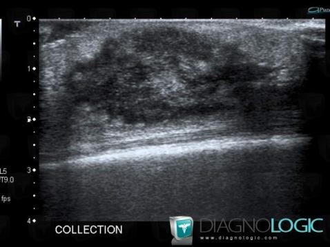 Abscess, Muscles - Leg, US