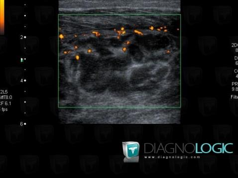 Abscess, Muscles - Leg, US