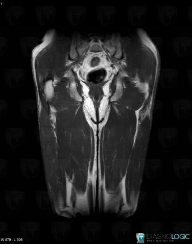 Abscess, Muscles - Thigh, MRI