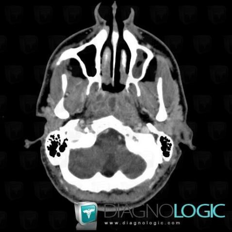 Radiology case : Peritonsillar abscess (CT) - Diagnologic