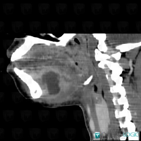 Abscess, Oropharynx / Floor-mouth, CT