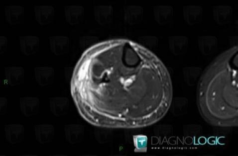 Abscess, Other soft tissues/nerves - Leg, MRI