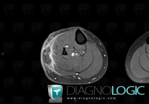 Abscess, Other soft tissues/nerves - Leg, MRI