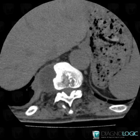 Abscess, Paraspinal, CT