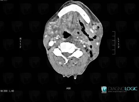 Abscess, Parotid and other salivary glands, CT