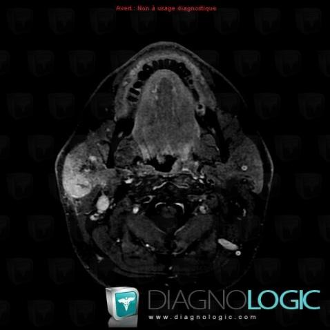 Abscess, Parotid and other salivary glands, MRI