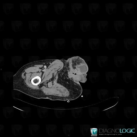 Abscess, Pelvic Muscles, CT