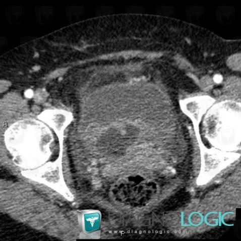 Abscess, Pelvis / Perineum, CT
