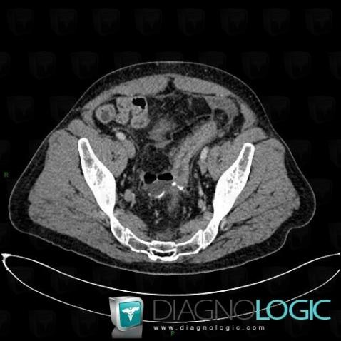 Abscess, Pelvis / Perineum, CT