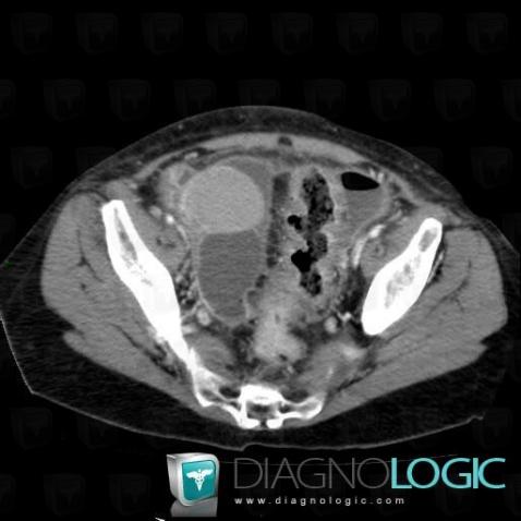 Abscess, Pelvis / Perineum, CT