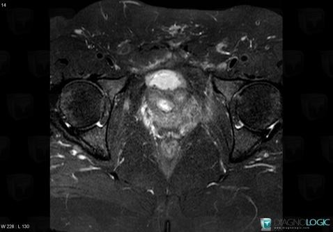 Abscess, Pelvis / Perineum, MRI