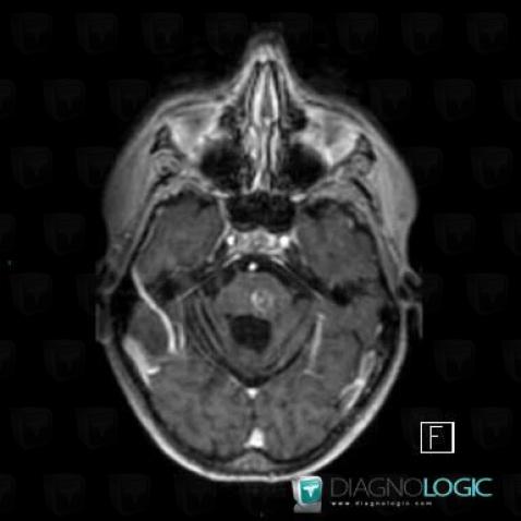 Abscess, Posterior fossa, MRI