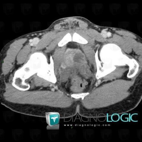 Abscess, Prostate, CT