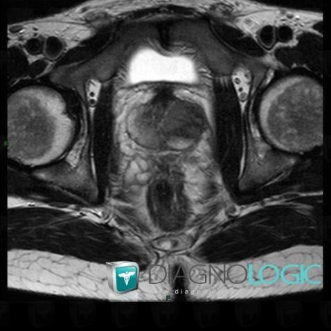 Abscess, Prostate, MRI