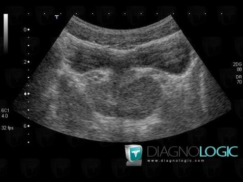 Abscess, Prostate, US