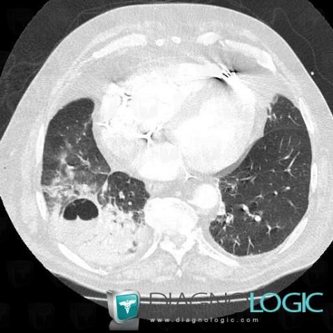 Abscess, Pulmonary parenchyma, CT