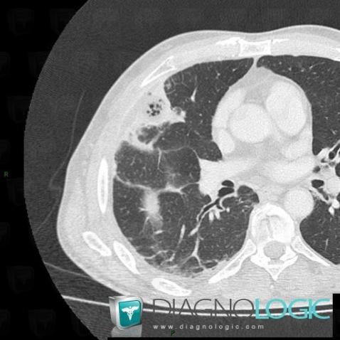 Abscess, Pulmonary parenchyma, CT