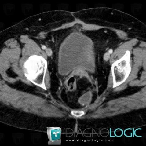 Abscess, Rectum, CT