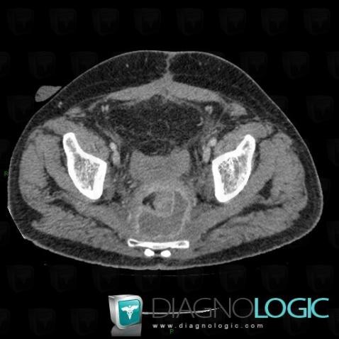 Abscess, Rectum, CT