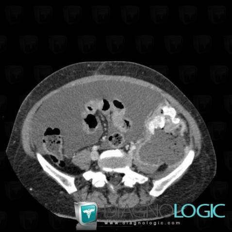 Abscess, Retroperitoneum, CT