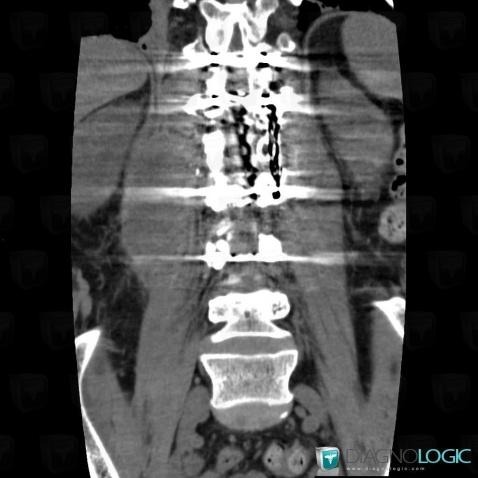 Abscess, Retroperitoneum, CT