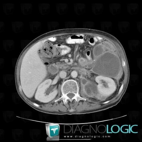 Abscess, Retroperitoneum, CT