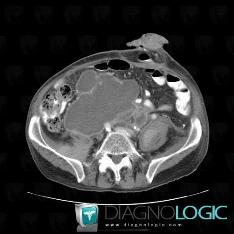 Abscess, Retroperitoneum, CT