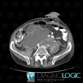 Abscess, Retroperitoneum, CT