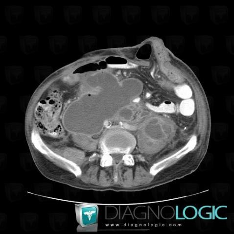 Abscess, Retroperitoneum, CT