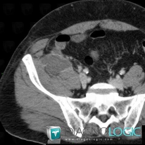 Abscess, Retroperitoneum, CT