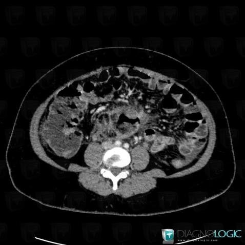 Abscess, Retroperitoneum, CT