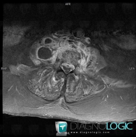 Abscess, Retroperitoneum, MRI