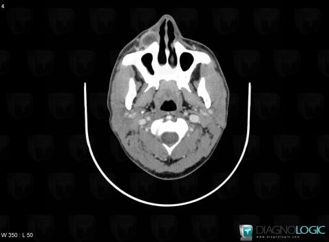 Abscess, Soft tissues - Head and neck, CT