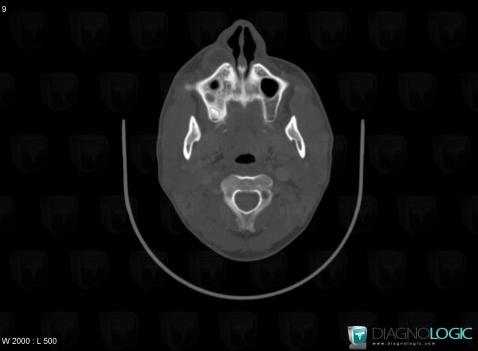 Abscess, Soft tissues - Head and neck, CT