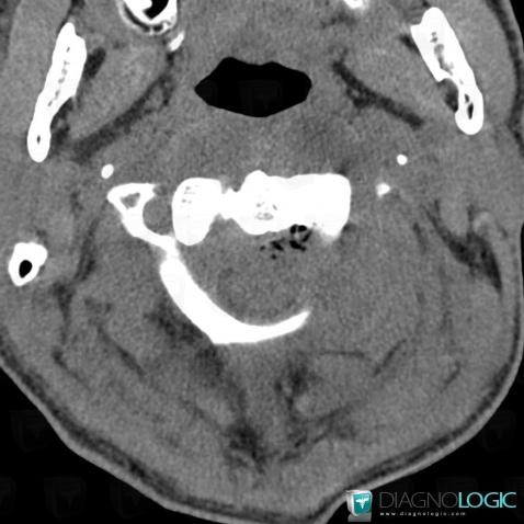 Abscess, Spinal canal / Cord, CT