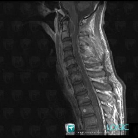 Abscess, Spinal canal / Cord, MRI