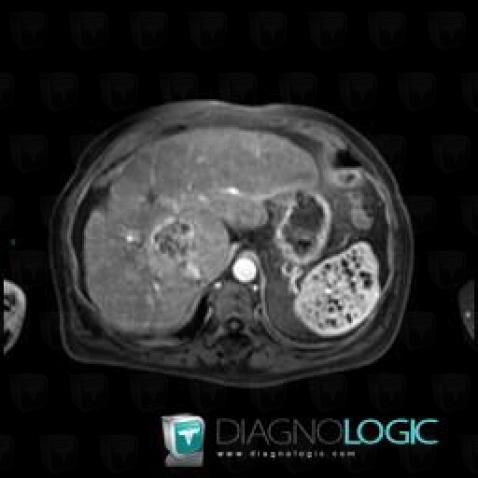 Abscess, Spleen, MRI