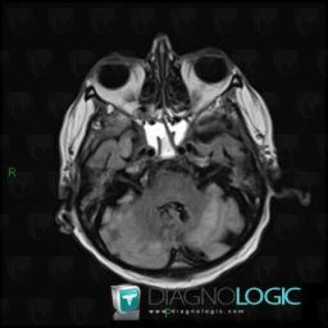 Accident vasculaire cérébral, Hémisphère cérébelleux, Fosse postérieure, IRM