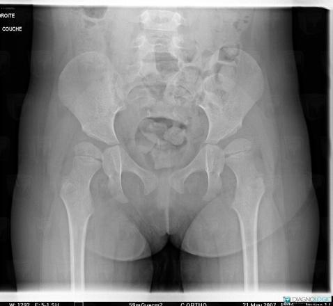 Acetabular dysplasia, Coxo femoral joint, X rays