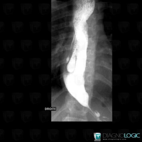 Achalasia, Oesophagus, X rays