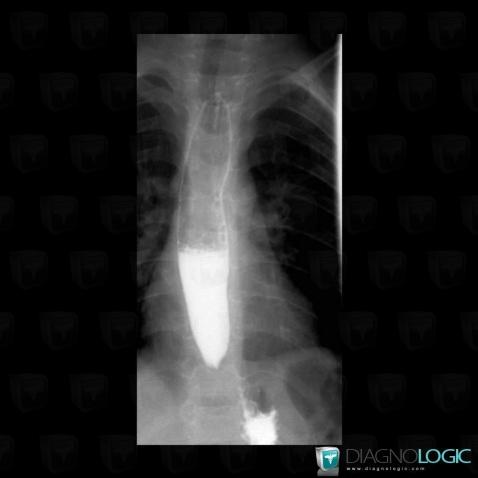 Achalasie, Oesophage, Radio