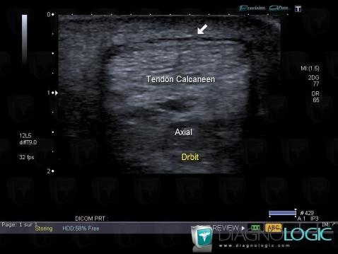 Achilles peritendinitis, Calcaneal tendon - Ankle, US