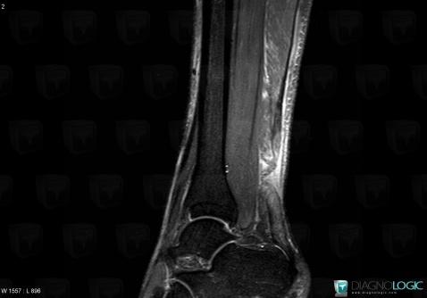 Achilles tendon rupture, Calcaneal tendon - Leg, Calcaneal tendon - Ankle, MRI