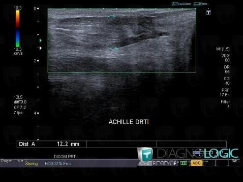 Achilles tendon rupture, Calcaneal tendon - Leg, Calcaneal tendon - Ankle, US