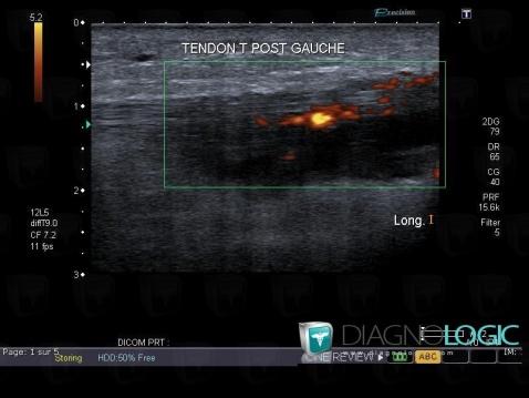 Achilles tendonitis, Calcaneal tendon - Ankle, US