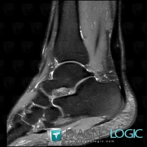 Achilles tendonitis, Calcaneal tendon - Leg, Calcaneal tendon - Ankle, MRI