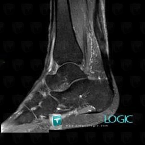 Radiology case : Achilles tendonitis (US ,MRI) - Diagnologic